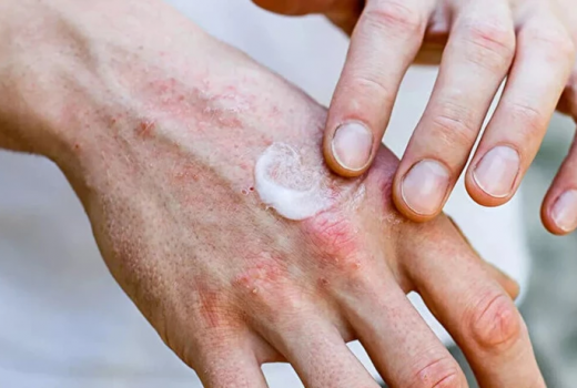 Egzama ile Vedalaşın: Doğanın Şifalı Yağlarıyla Cildinizi Sakinleştirin