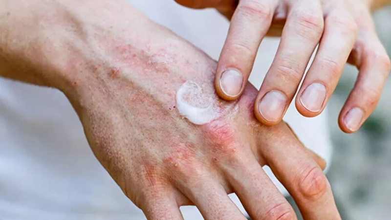 Egzama ile Vedalaşın: Doğanın Şifalı Yağlarıyla Cildinizi Sakinleştirin